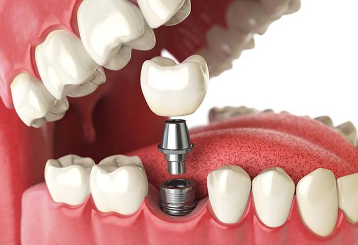 Udaipur Dental Clinic Dental Implant