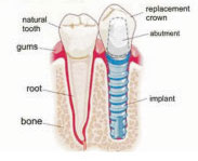 Dental Implant